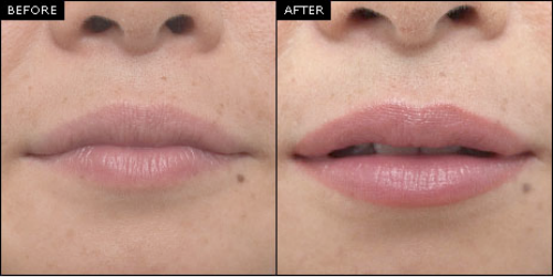 Lips before and after